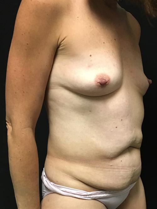 Breast Lift With Implants Before & After Image