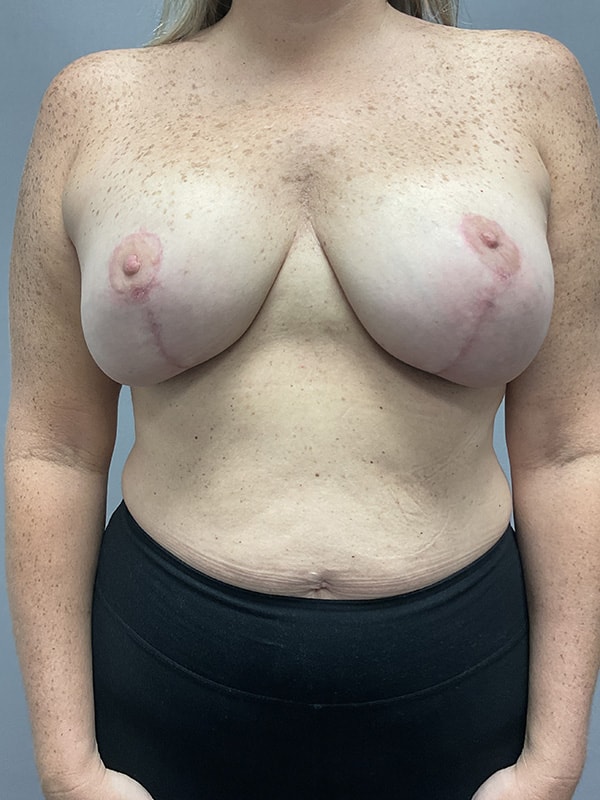 Breast Lift With Implants Before & After Image