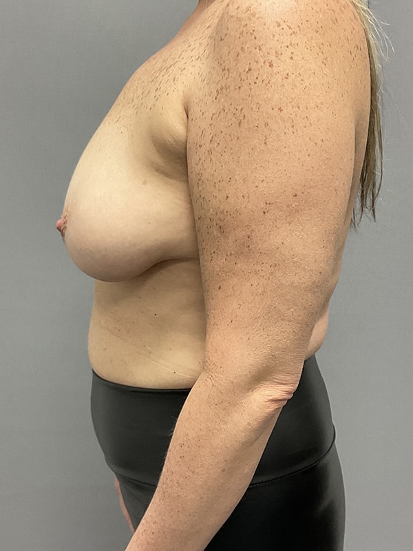 Breast Lift With Implants Before & After Image