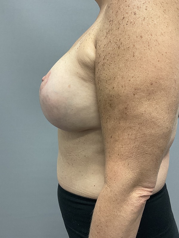 Breast Lift With Implants Before & After Image