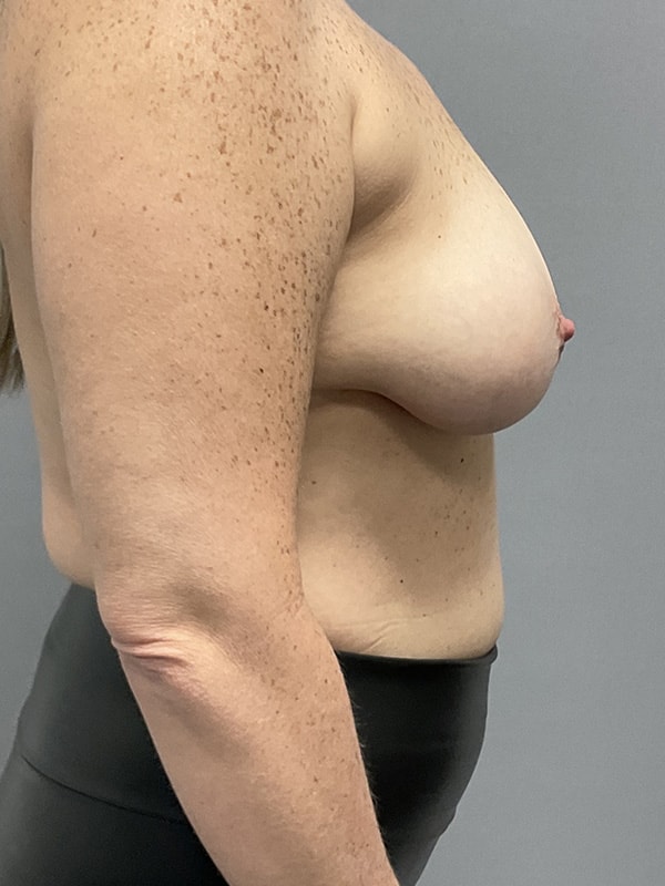 Breast Lift With Implants Before & After Image