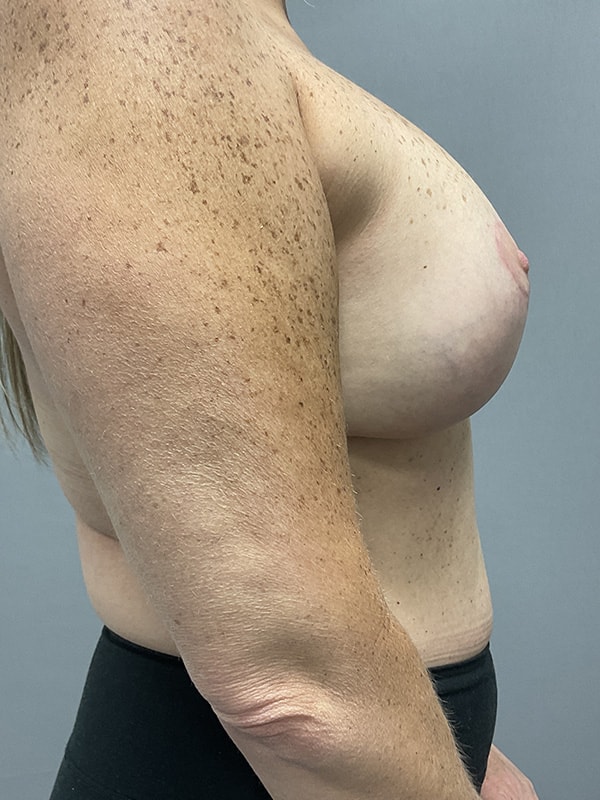 Breast Lift With Implants Before & After Image