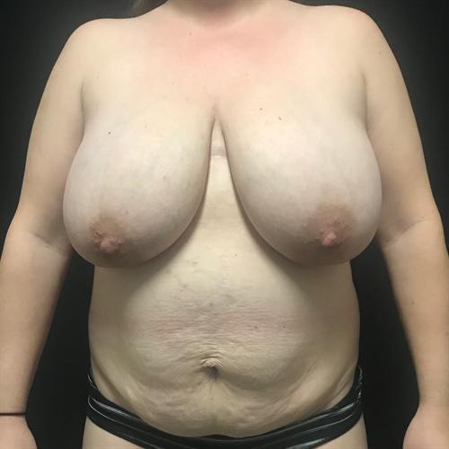 Breast Lift Before & After Image