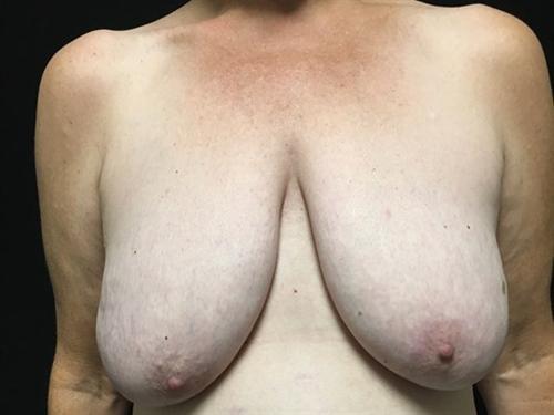 Breast Lift Before & After Image