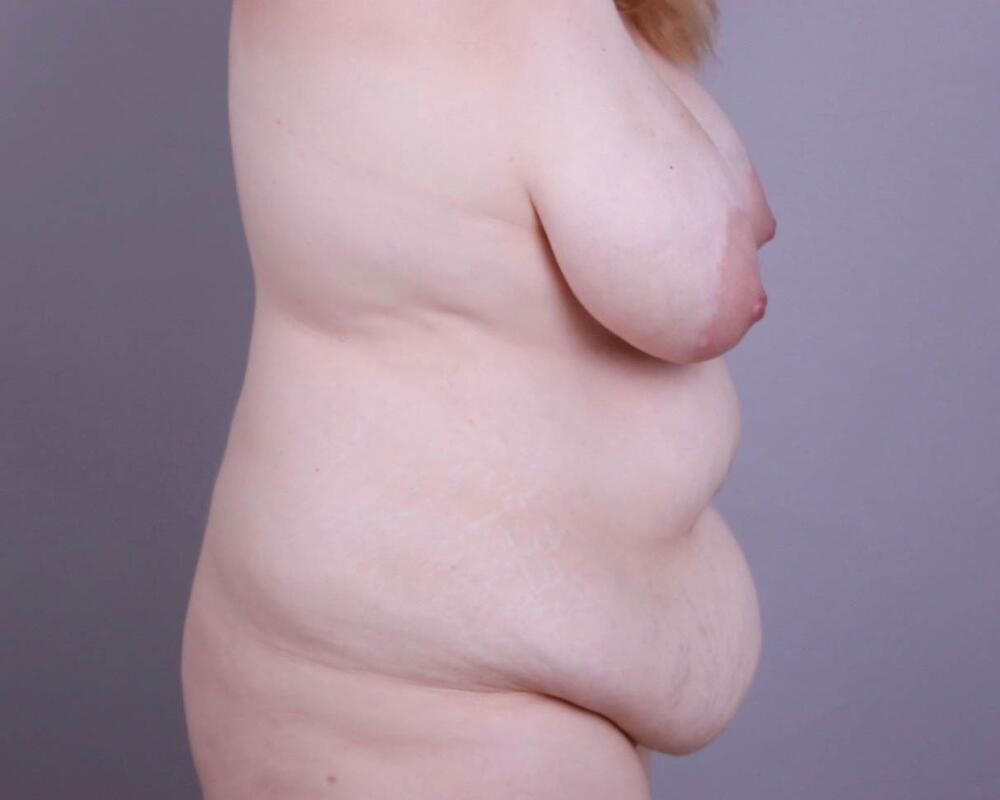 Breast Lift Before & After Image