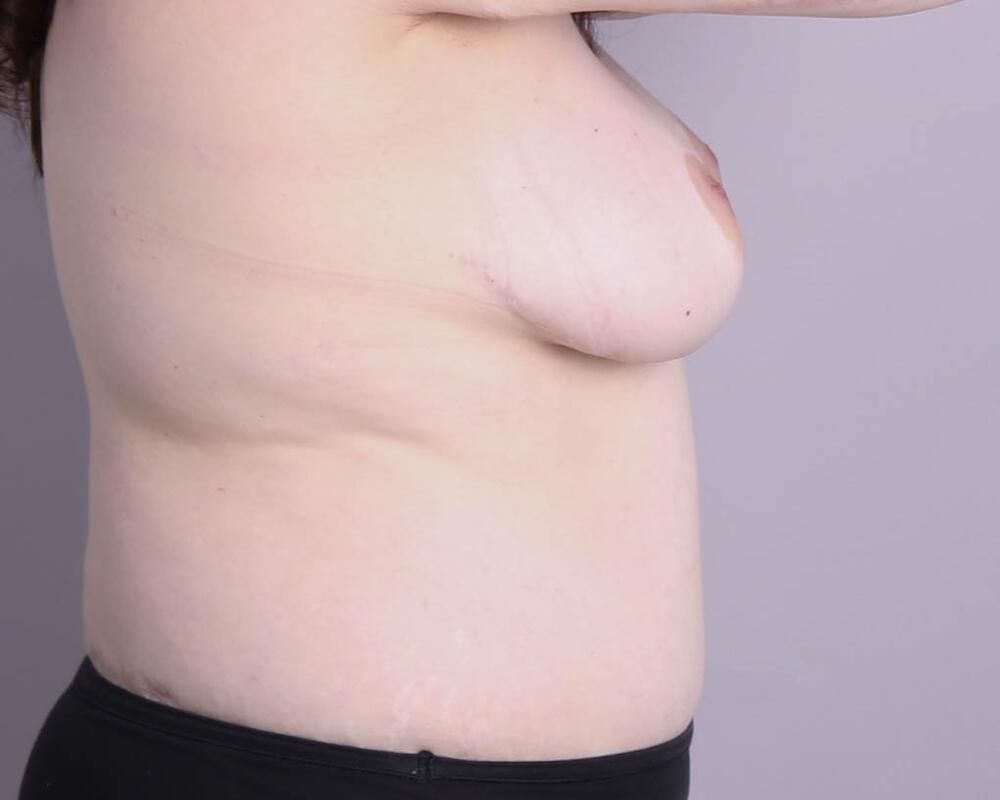 Breast Lift Before & After Image