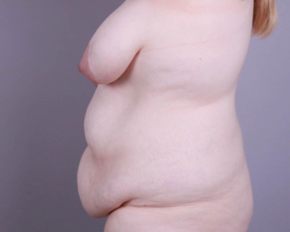 Breast Lift Before & After Image