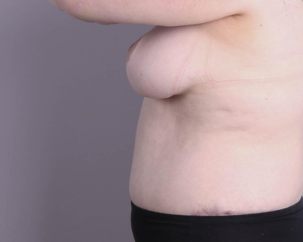 Breast Lift Before & After Image