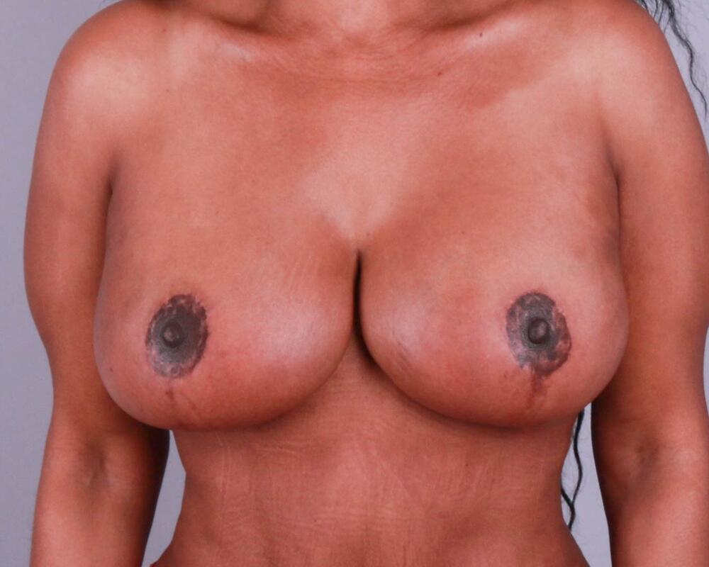 Breast Lift Before & After Image