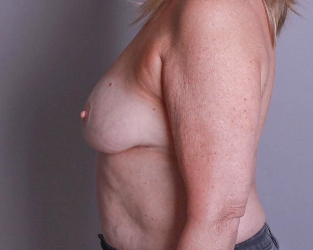 Breast Lift Before & After Image