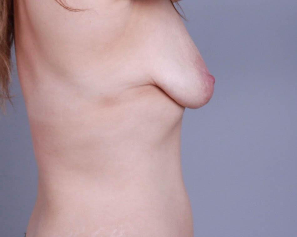 Breast Lift Before & After Image