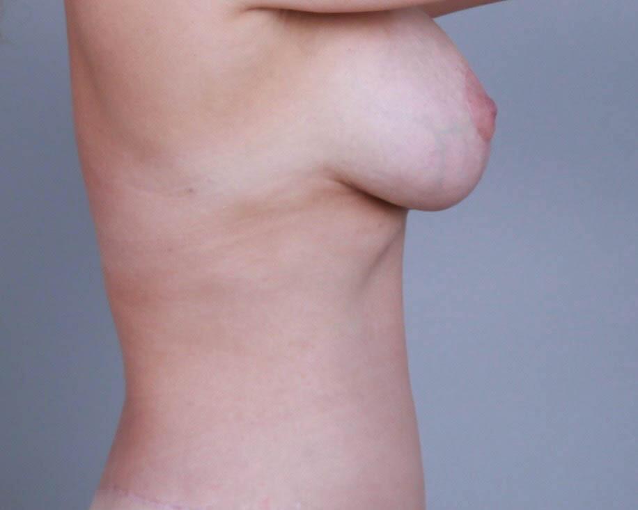 Breast Lift Before & After Image