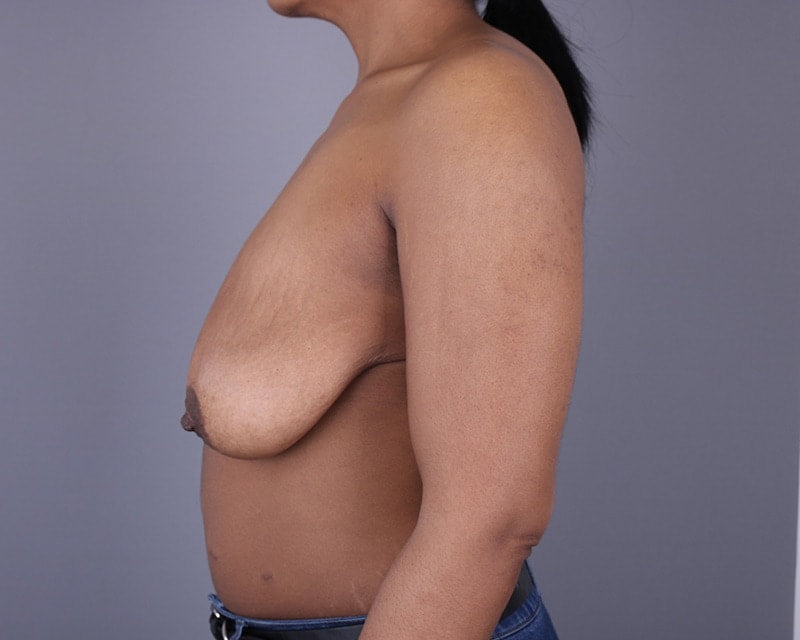 Breast Lift Before & After Image