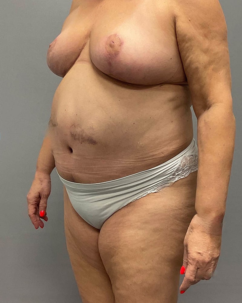 Breast Lift Before & After Image