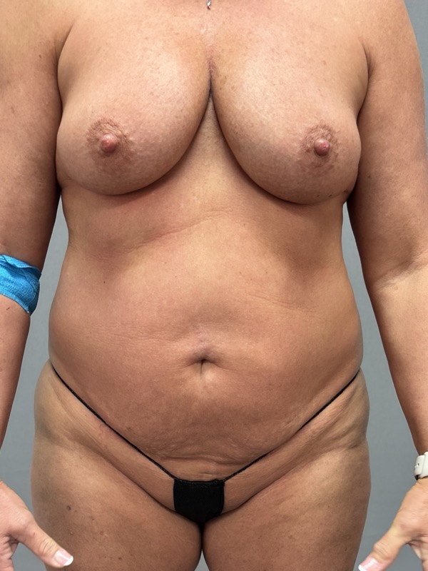 Breast Lift Before & After Image