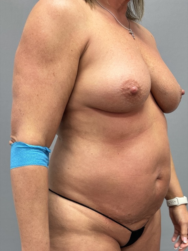 Breast Lift Before & After Image