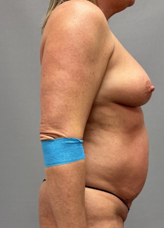 Breast Lift Before & After Image