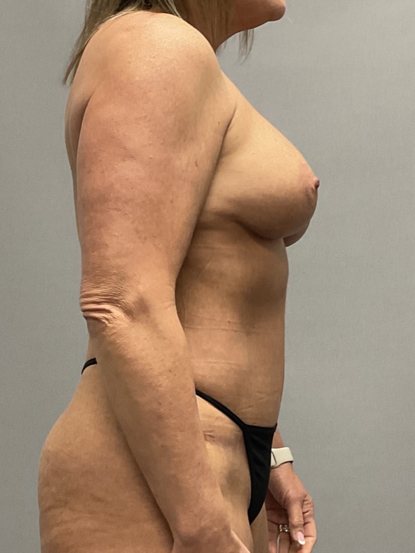 Breast Lift Before & After Image