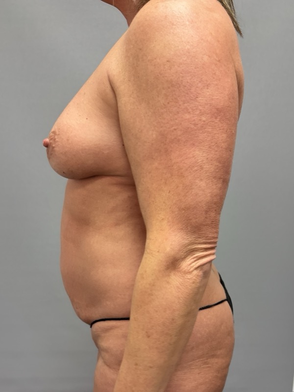 Breast Lift Before & After Image