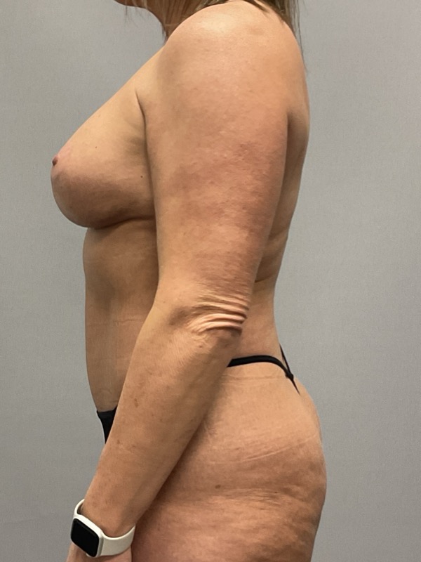 Breast Lift Before & After Image