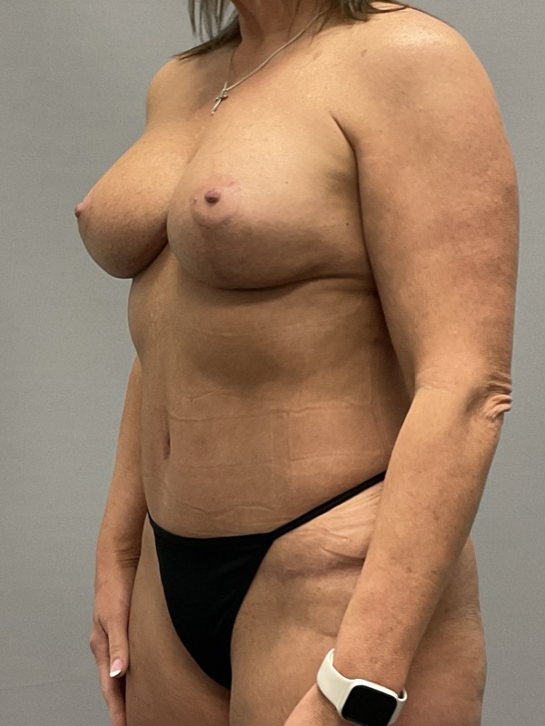Breast Lift Before & After Image