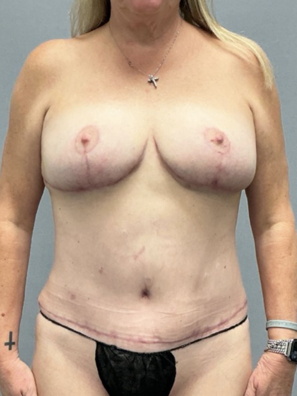 Breast Lift Before & After Image