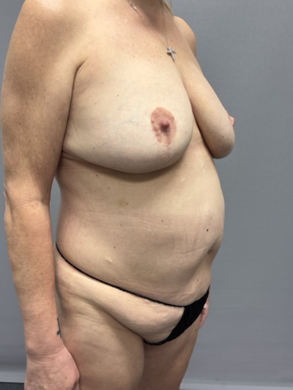 Breast Lift Before & After Image