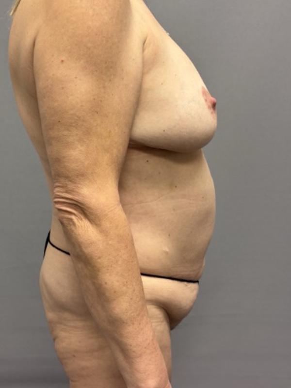 Breast Lift Before & After Image