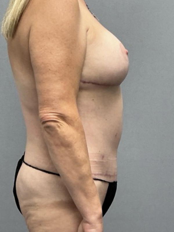 Breast Lift Before & After Image