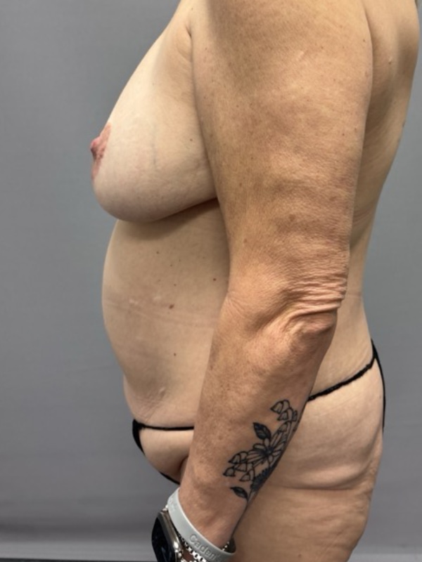 Breast Lift Before & After Image