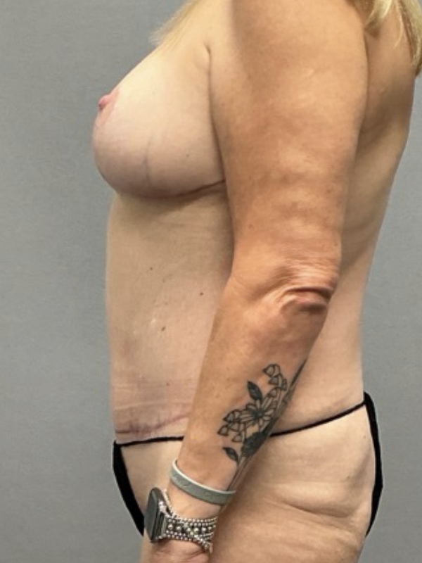 Breast Lift Before & After Image