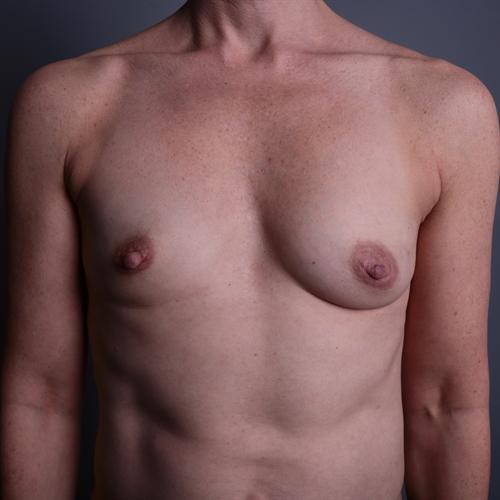 Breast Reconstruction Before & After Image