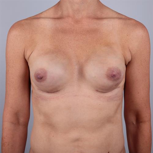 Breast Reconstruction Before & After Image