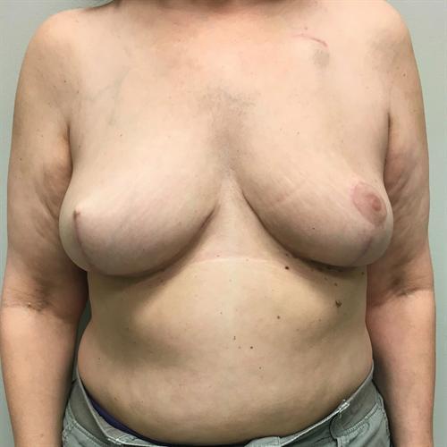 Breast Reconstruction Before & After Image