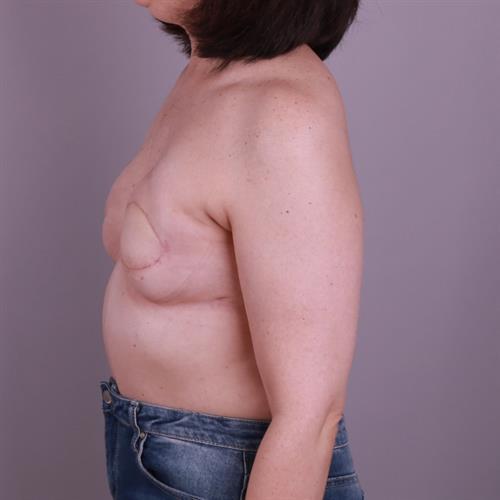 Breast Reconstruction Before & After Image