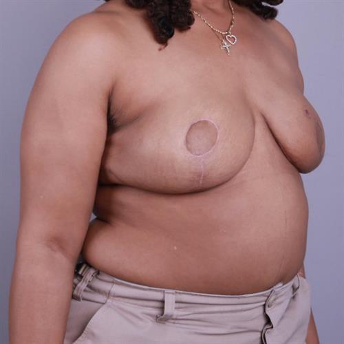 Breast Reconstruction Before & After Image