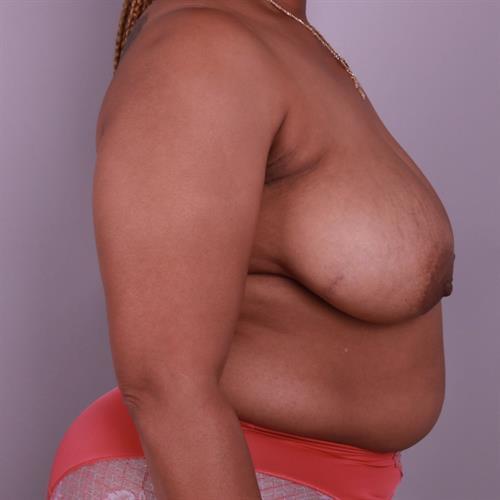 Breast Reconstruction Before & After Image