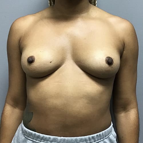 Breast Reconstruction Before & After Image