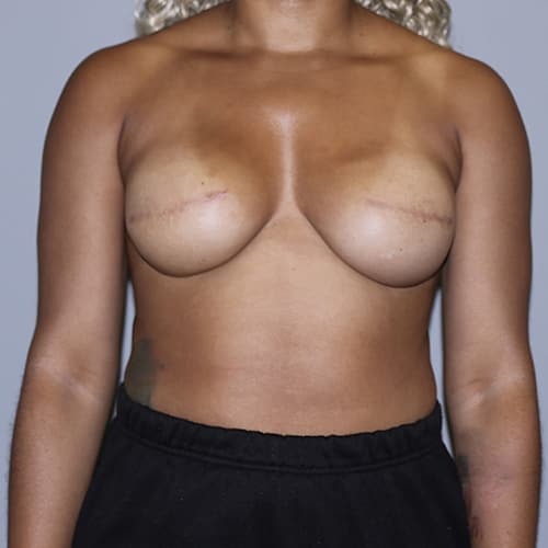 Breast Reconstruction Before & After Image