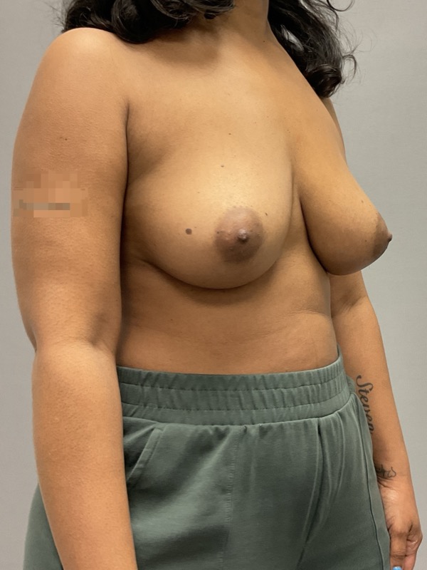 Breast Reconstruction Before & After Image