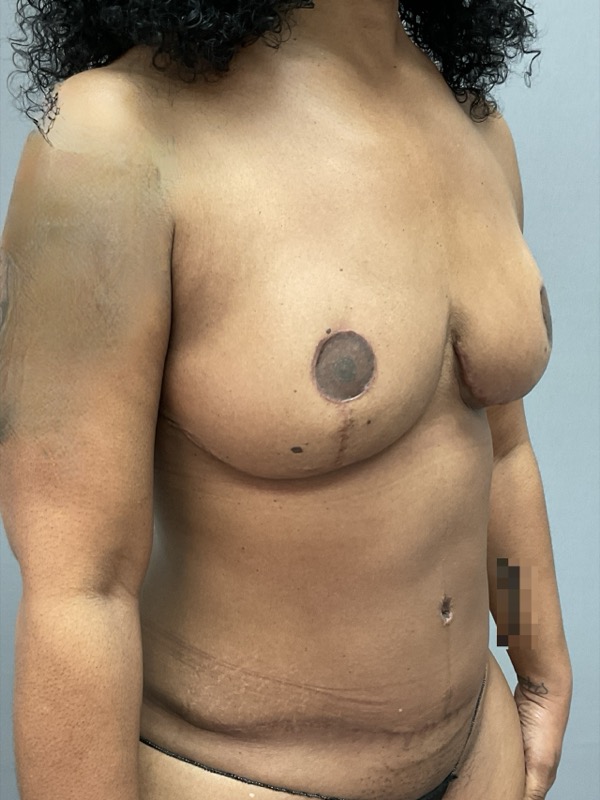 Breast Reconstruction Before & After Image