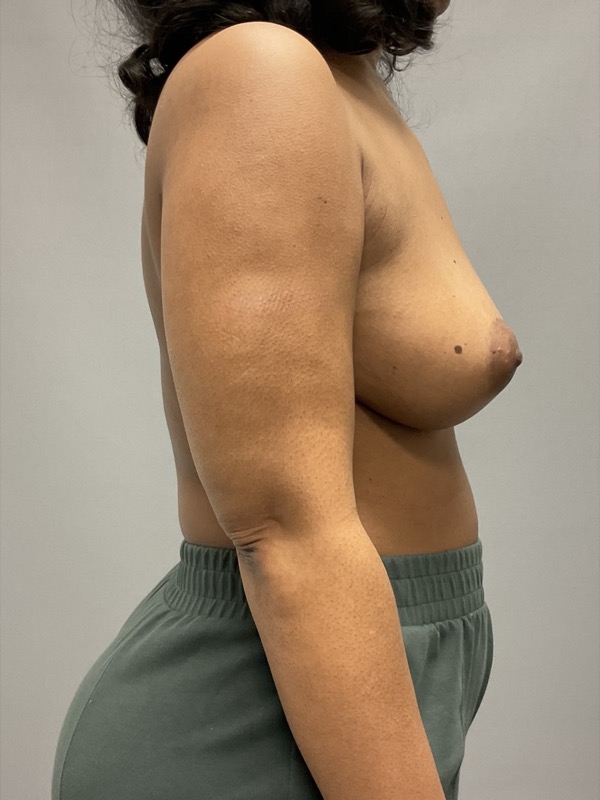 Breast Reconstruction Before & After Image