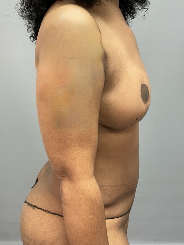 Breast Reconstruction Before & After Image