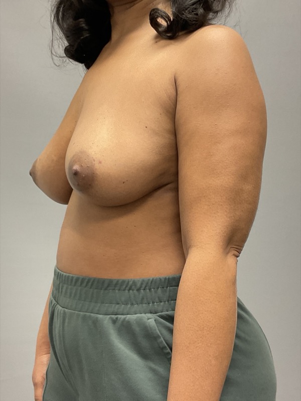 Breast Reconstruction Before & After Image