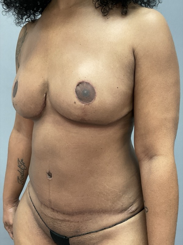 Breast Reconstruction Before & After Image