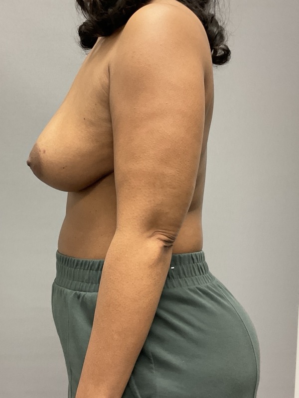 Breast Reconstruction Before & After Image
