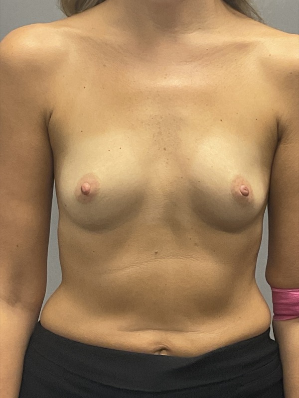 Breast Reconstruction Before & After Image