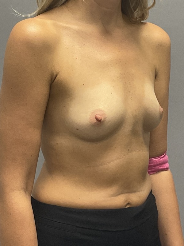 Breast Reconstruction Before & After Image