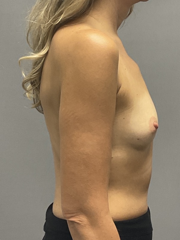 Breast Reconstruction Before & After Image