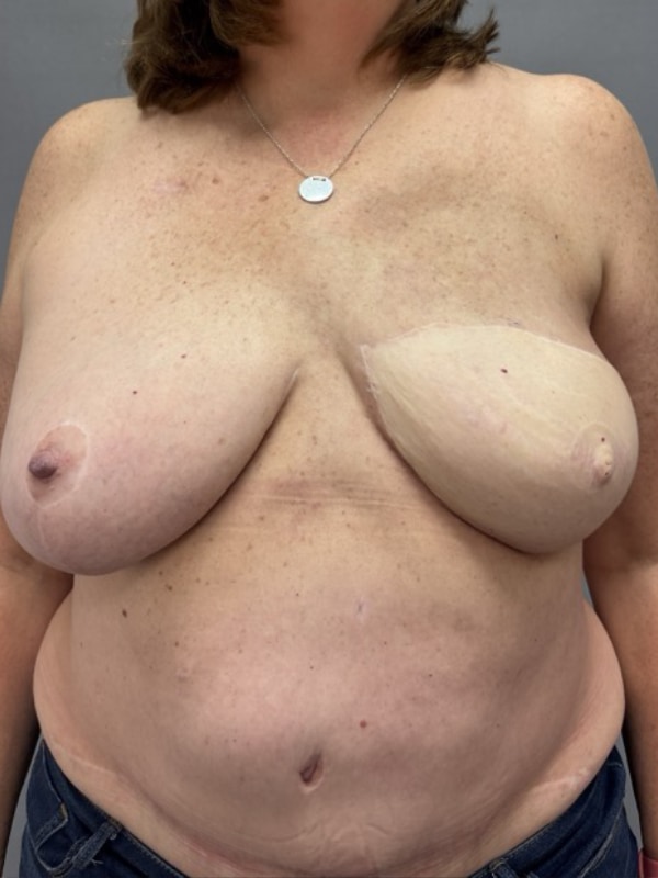 Breast Reconstruction Before & After Image